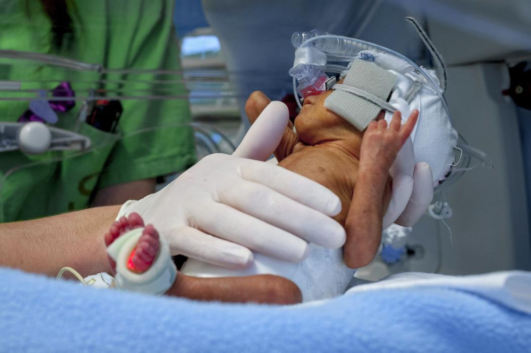 تولد نوزاد زودرس در مجارستان