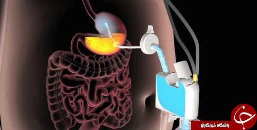 جدیدترین دستگاه لاغری بدون جراحی/عکس