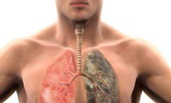 شاید شما هم آسم داشته باشید/ خوراکی‌های خطرناک برای بیماران تنفسی
