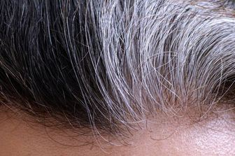 سفیدی مو