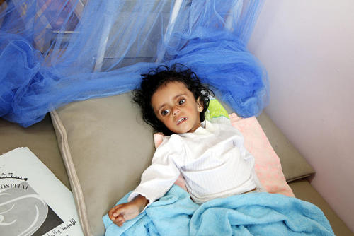 یک کودک دچار سوء تغذیه شدید در بیمارستانی در شهر صنعا یمن