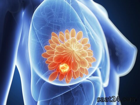 سرطان پستان | درمان سرطان سینه چیست؟