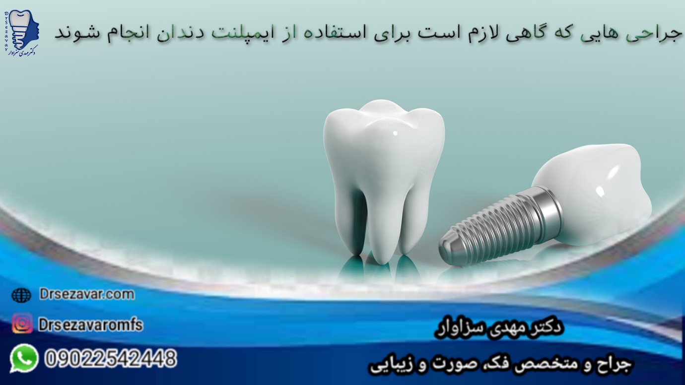 جراحی هایی که گاهی لازم است برای استفاده از ایمپلنت دندان انجام شوند