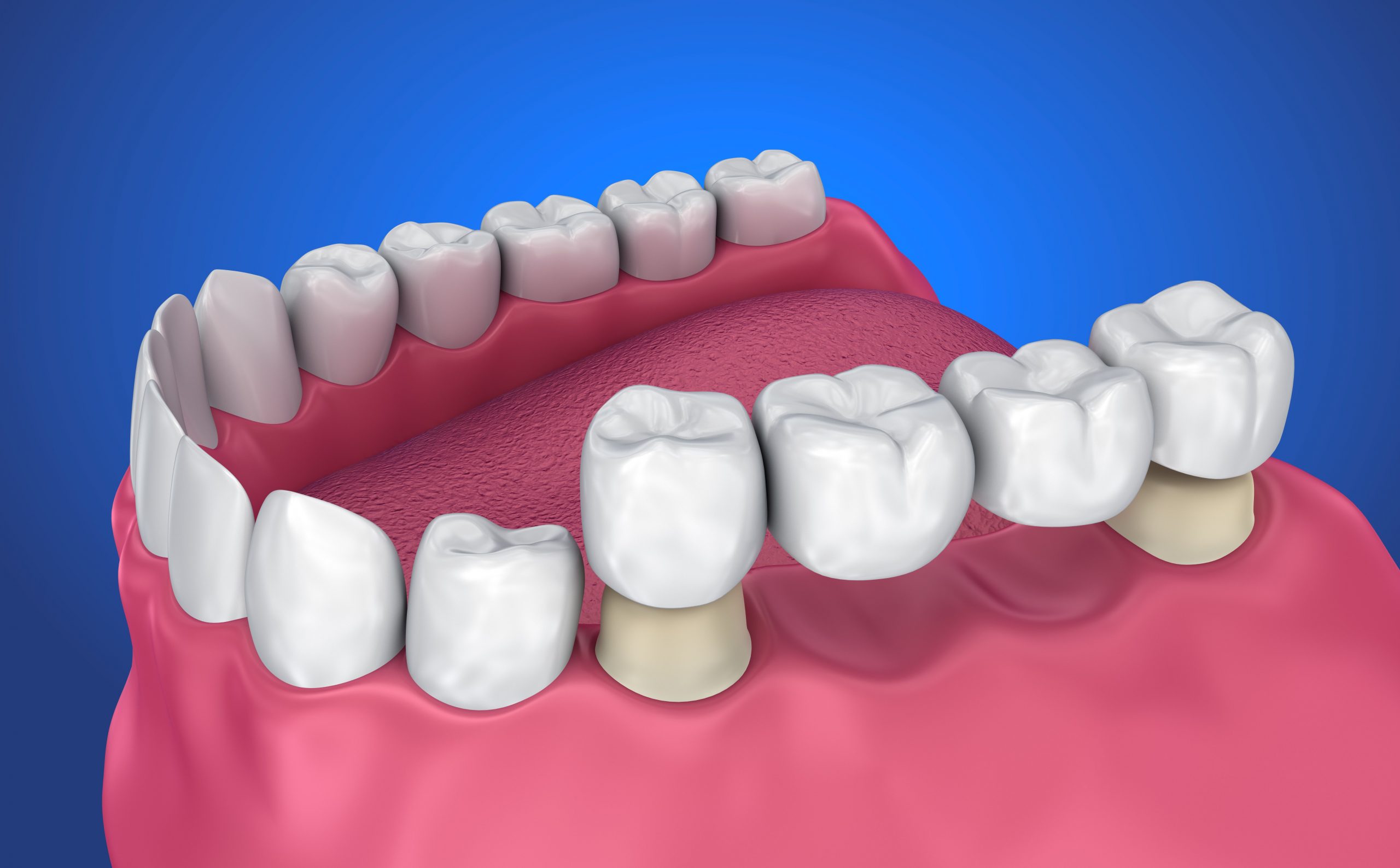 بررسی فرق بریج و کامپوزیت
