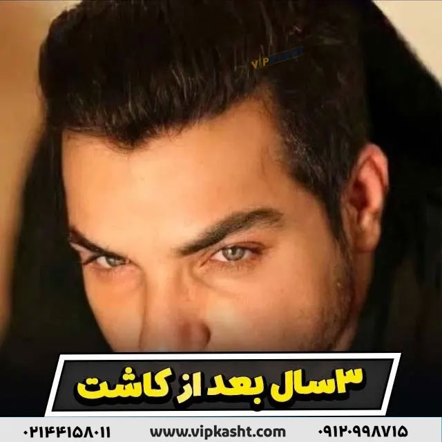 بهترین و بزرگترین کلینیک کاشت مو تهران