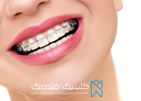 اقدامات قبل از ارتودنسی دندان چیست؟
