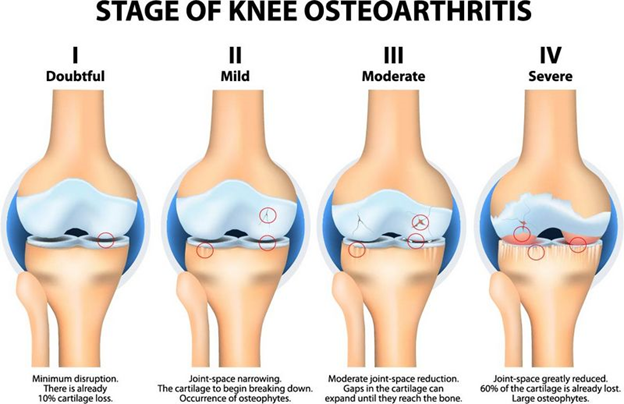 جدید ترین راه درمان آرتروز زانو با سلول جفت یا Arthrocell