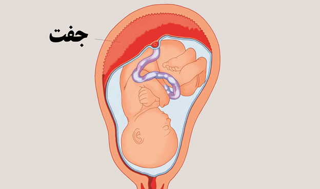 جدید ترین راه درمان آرتروز زانو با سلول جفت یا Arthrocell