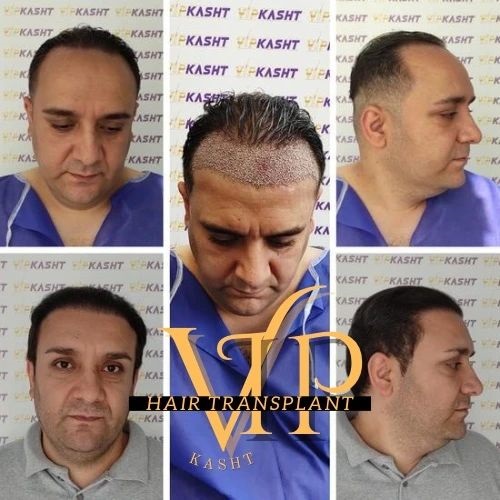 کلینیک کاشت مو تهران سعادت آباد