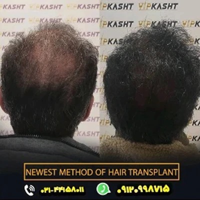 کلینیک کاشت مو تهران سعادت آباد