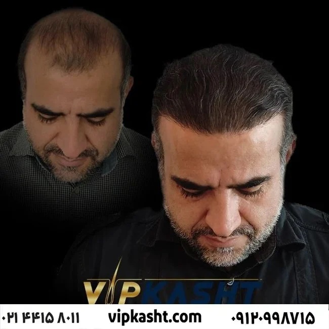 کلینیک کاشت مو تهران سعادت آباد