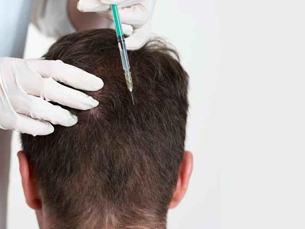 مزوتراپی مو چیست؟ مزایا و معایب این روش 