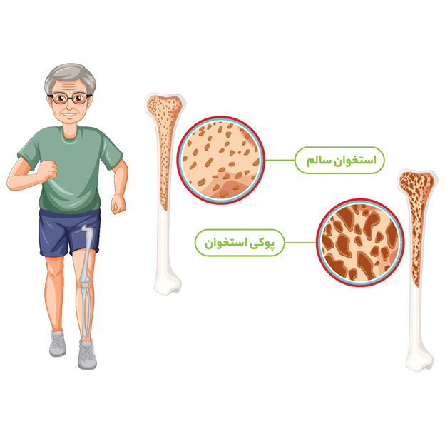 کلسیم به تنهایی برای پوکی استخوان کافی نیست!