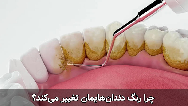 تفاوت جرم گیری و بلیچینگ