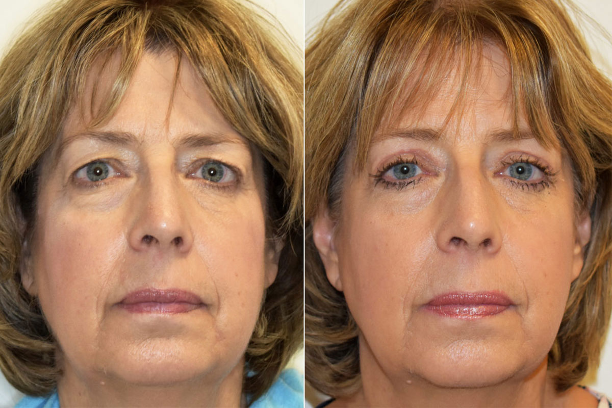 Blepharoplasty | Philadelphia, PA | Eyelid Lift | Dr. Lozada