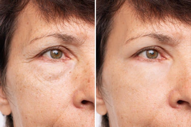 Eyelid Surgery Cincinnati | Blepharoplasty Florence, KY