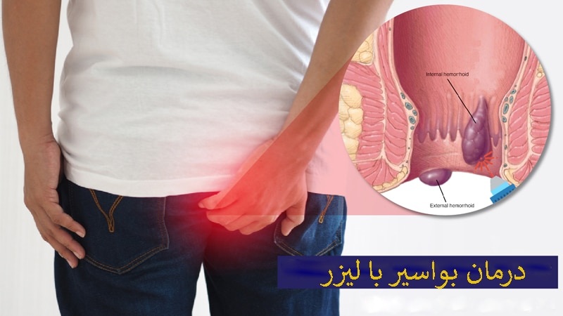 لیزر هموروئید در تهران