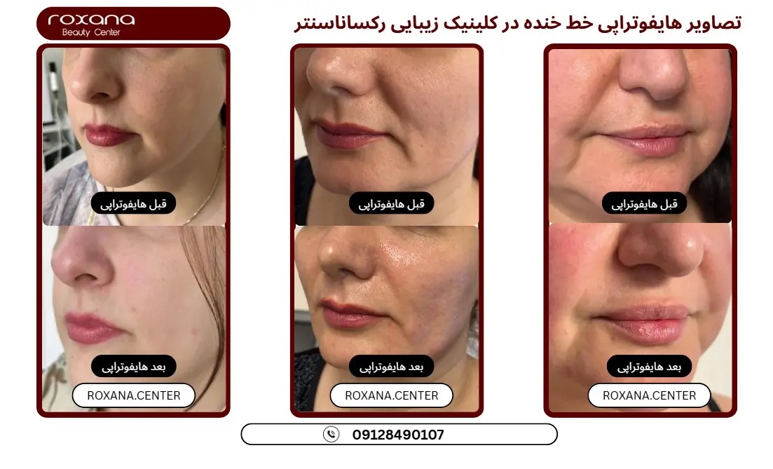 هایفوتراپی در تهران