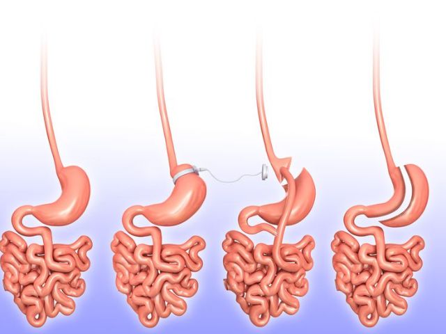 رایجترین متد جراحی لاغری