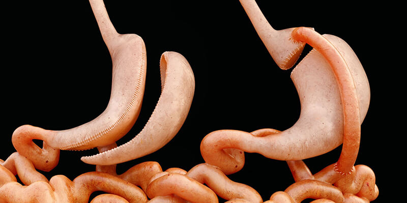 جراح بای پس معده در تهران