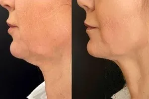 با اقساط 12 ماهه صورت و غبغبت رو اندولیفت کن 😍