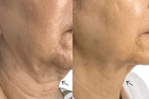 صورت بعد از اندولیفت، شادابتر، جوانتر و پرانرژیتر از قبل شده 🤩🤩