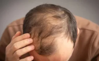 آمپول‌های کاهش وزن اوزمپیک و وگووی، احتمال ریزش مو در آقایان را بالا می‌برند!