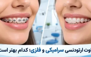 تفاوت بین ارتودنسی سرامیکی و فلزی؛ کدام یک برتر است؟